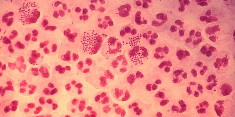 Gonorrea resistente: nuovi test e due terapie cambiano le cure